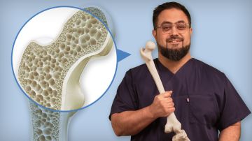 Osteoporose: Diagnostik, Therapie und Prävention